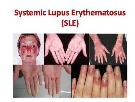 Biểu hiện của Lupus ban đỏ