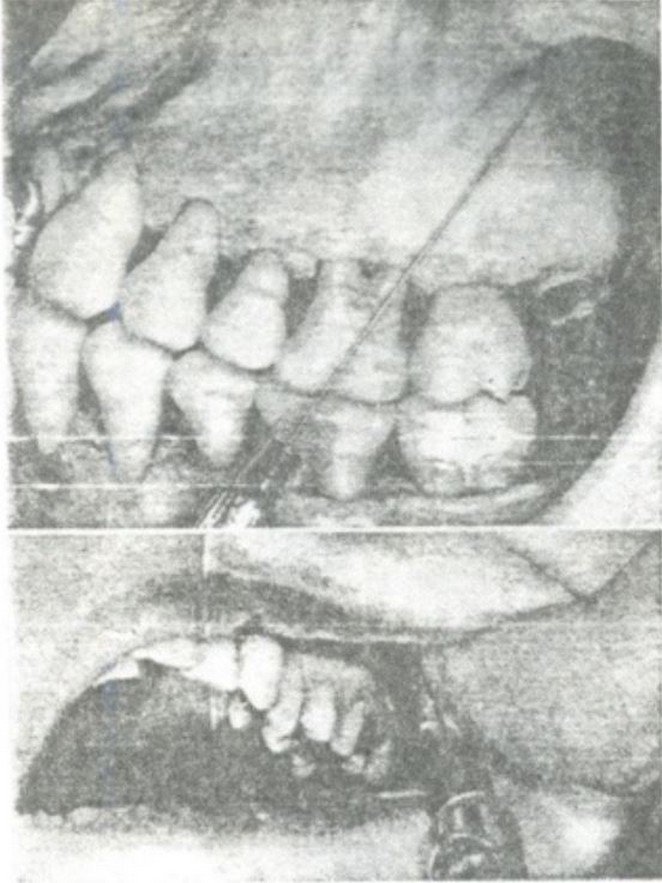 Gây tê dây thần kinh răng trên sau (H.4)