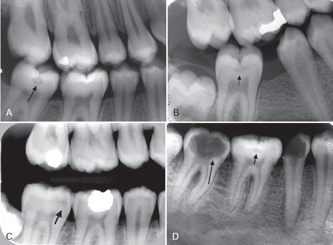 hình ảnh phóng đại phát hiện sâu men vùng răng cối nhỏ