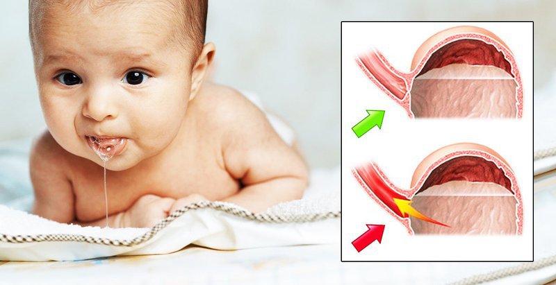 Đừng lơ là với trào ngược dạ dày thực quản ở trẻ sơ sinh