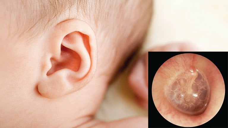 Viêm tai giữa ở trẻ