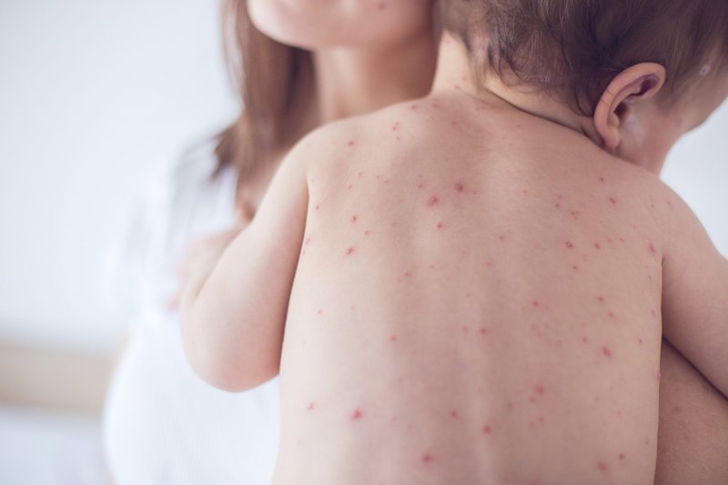 diễn biến bệnh sốt xuất huyết ở trẻ em