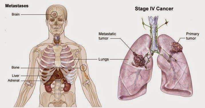 ung thư phổi biểu hiện