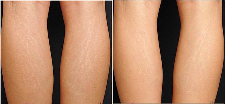 Biện pháp cải thiện rạn da ở bắp chân?