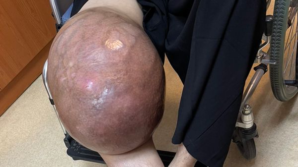 Hình ảnh một bệnh nhân đến bệnh viện Vinmec khi khối u đã to như quả dưa hấu.