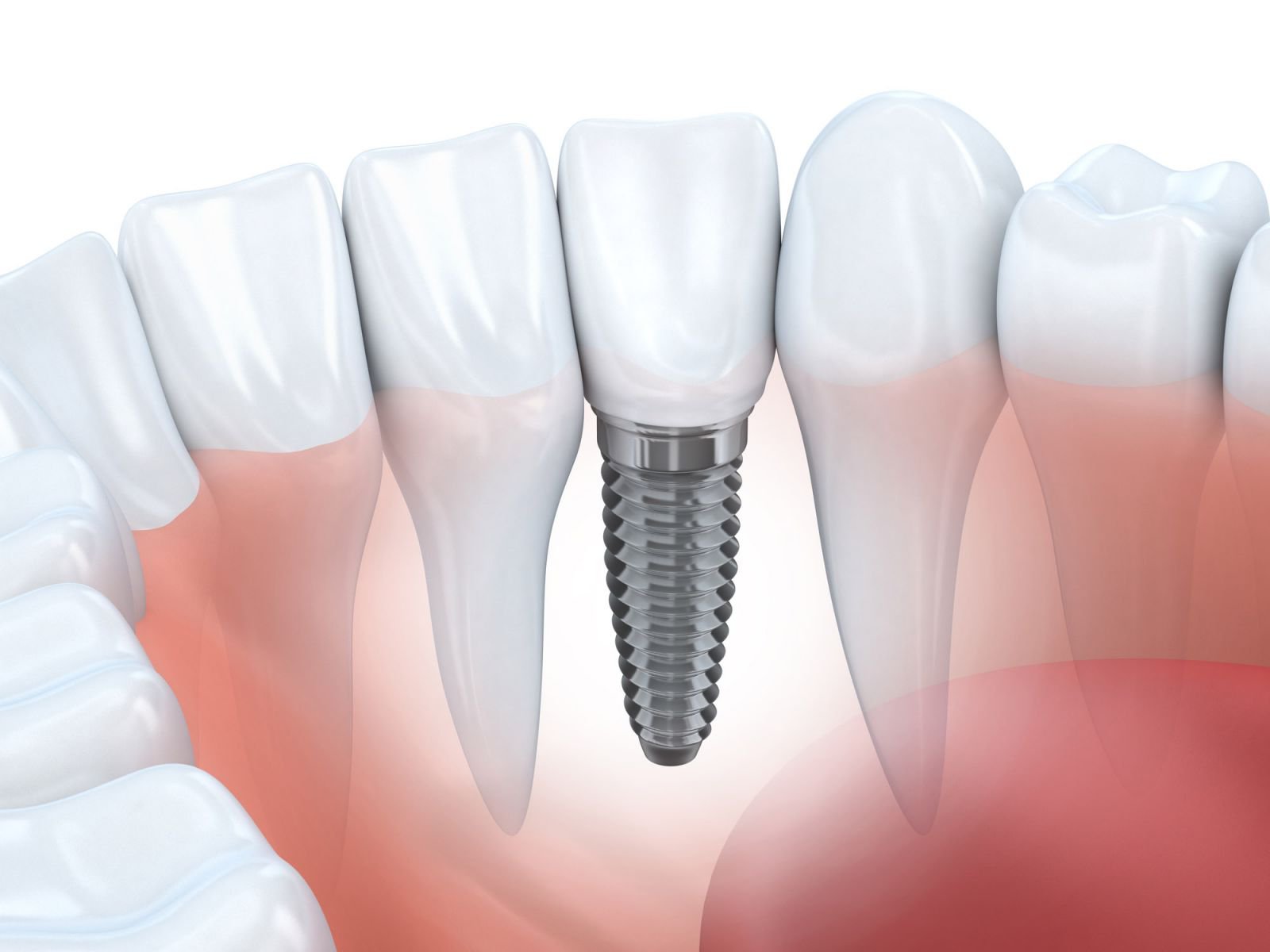 răng giả implant