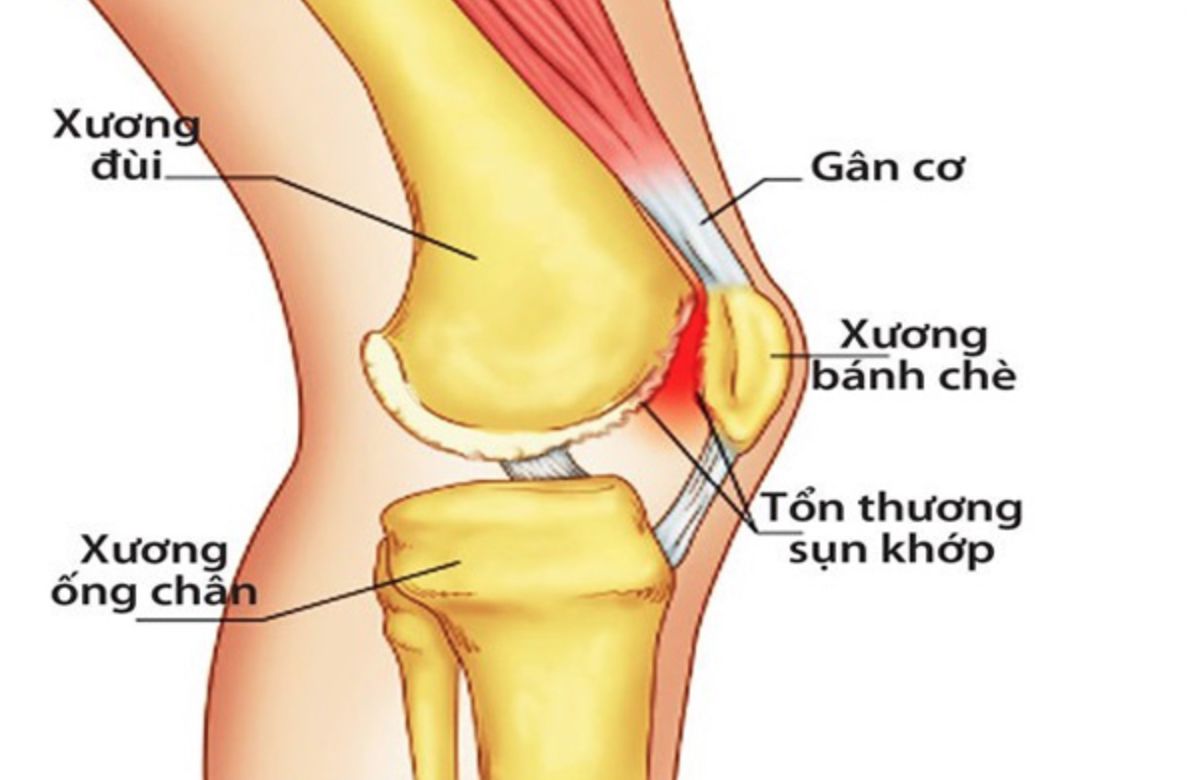 Những điều cần biết về Nhức mỏi đầu gối
