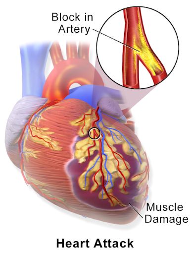 Nhồi máu cơ tim là gì – Tìm hiểu cùng bác sĩ