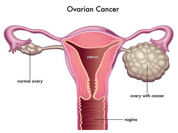 ung thư cổ tử cung1
