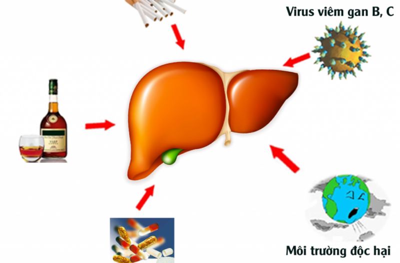 Tại sao những người thường uống rượu bia cần làm tầm soát ung thư gan?