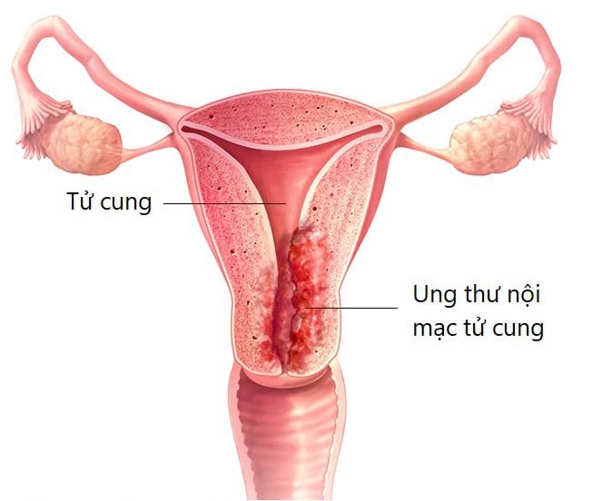 Ung thư nội mạc tử cung: Triệu chứng, nguyên nhân và tầm soát bệnh