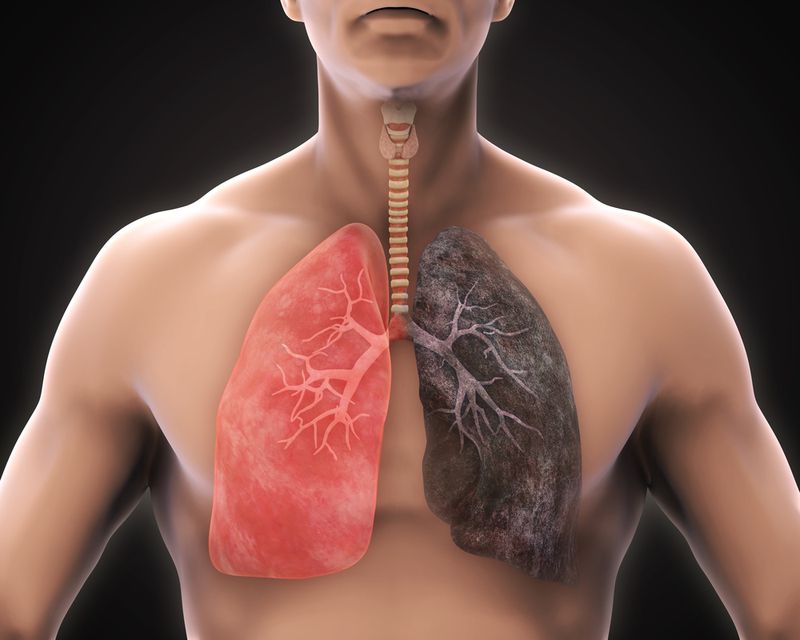 sàng lọc ung thư phổi