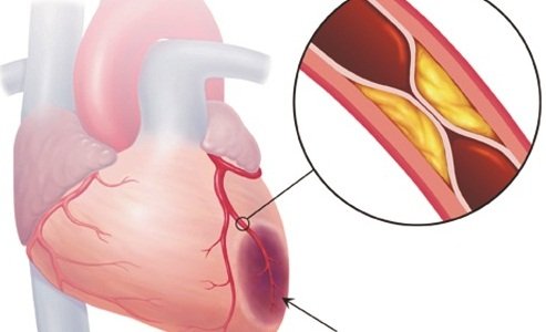 Chụp mạch vành - tác dụng kép trong chẩn đoán và điều trị bệnh mạch vành