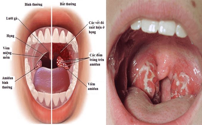 Biểu hiện của viêm VA mạn tính là gì?