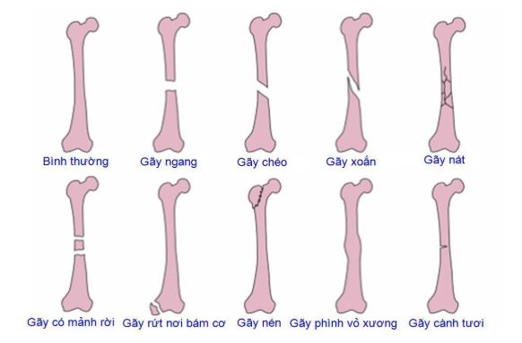 phân loại gãy xương