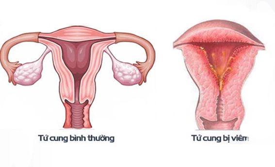 viêm nội mạc tử cung