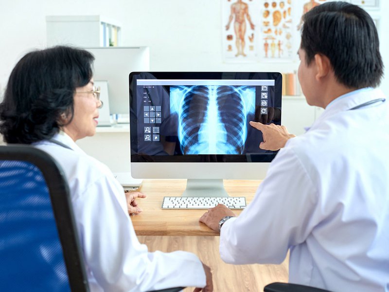 chụp X quang ung thư phổi