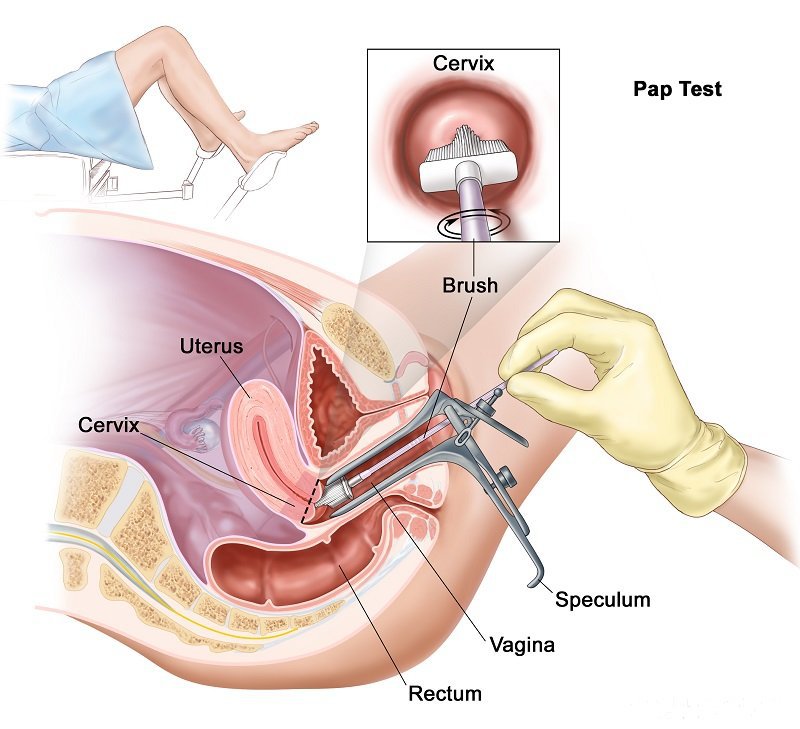 Xét nghiệm Pap là phương pháp kiểm tra sàng lọc ung thư cổ tử cung