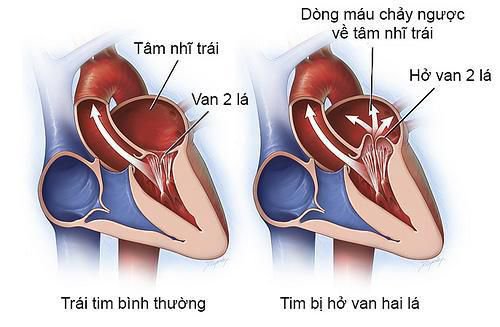 Hở van 2 lá khiến máu chảy ngược về tim