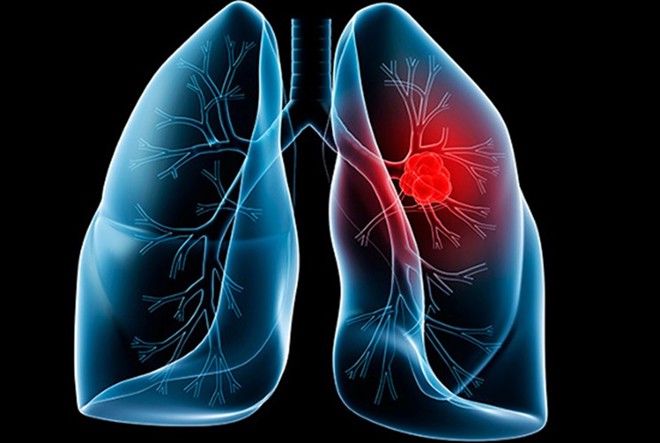 Ung thư vú di căn phổi