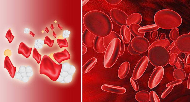Tế bào máu bị bệnh Thalassemia