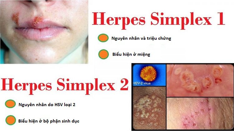 Virus HSV gây mụn rộp sinh dục