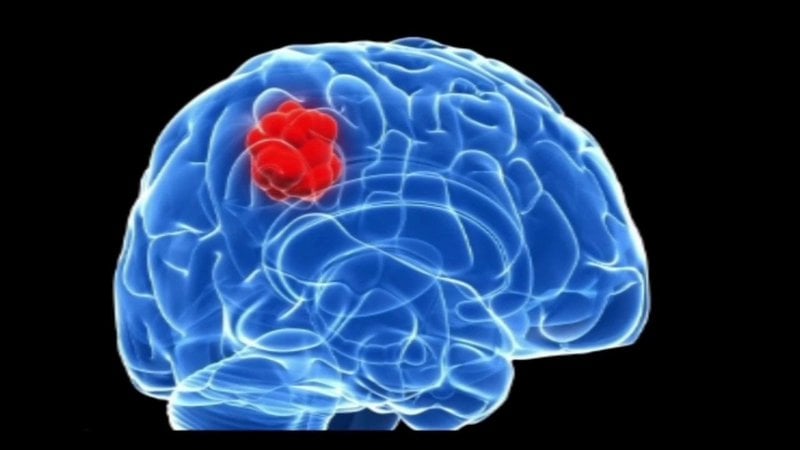 Triệu chứng u não và cách điều trị