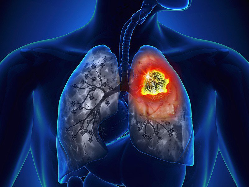 Có những loại ung thư phổi nào?
