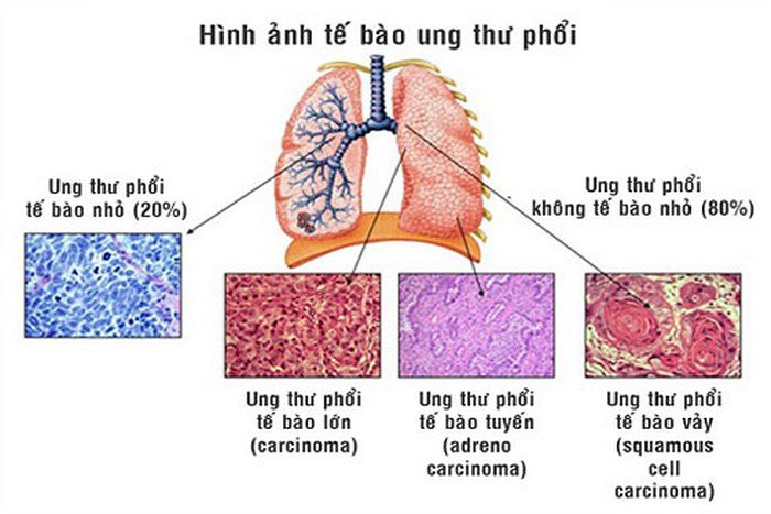 Có những loại ung thư phổi nào?