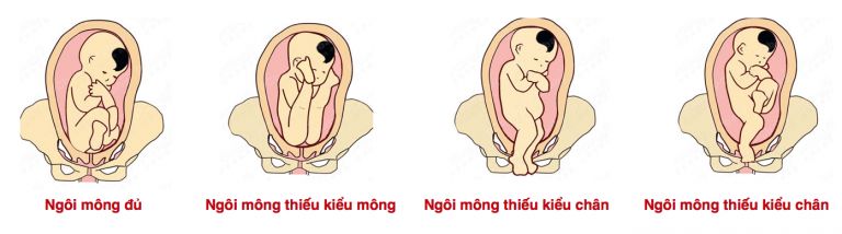 Ngôi thai là gì? Những bất thường thường gặp ở ngôi thai