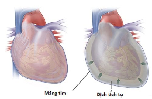 Siêu âm tim qua thành ngực là gì?