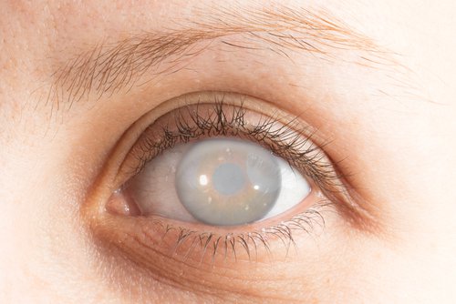 Bệnh đục thủy tinh thể có thể gây mù lòa - Cần khám những gì để phát hiện bệnh?