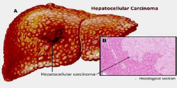 Ung thư tế bào biểu mô gan