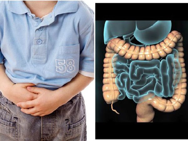 Hội chứng ruột kích thích ở trẻ em