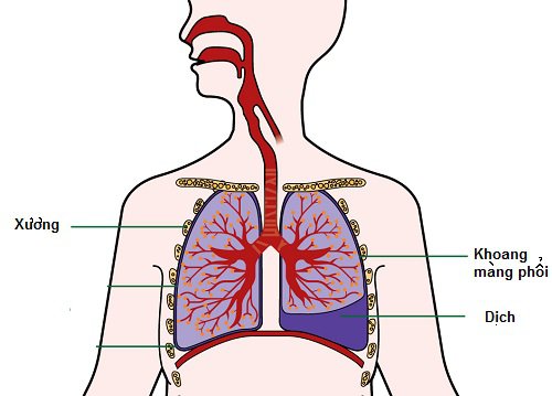 Tràn dịch màng phổi ác tính là gì?
