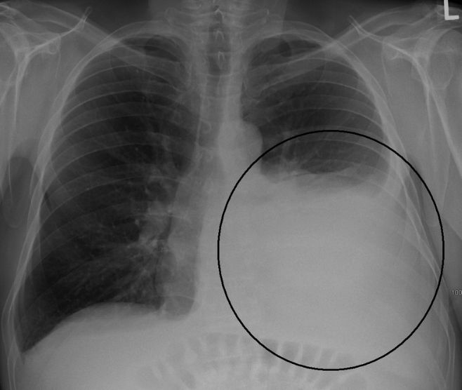 Hình ảnh tràn dịch màng phổi trên phim X-quang