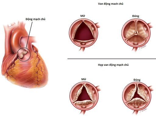Thấp tim có thể gây hở van động mạch chủ