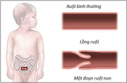 Bệnh lồng ruột dễ gặp ở trẻ dưới 2 tuổi