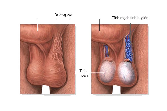 Giãn tĩnh mạch tinh