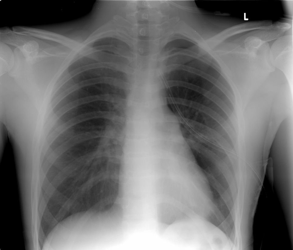 Tìm hiểu hội chứng ba giảm trong tràn dịch màng phổi