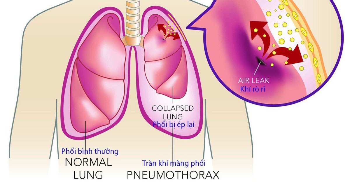Tổng quan các bệnh thường gặp ở phổi