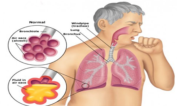 Bệnh lao phổi: Tiêm phòng rồi có bị lây nữa không?