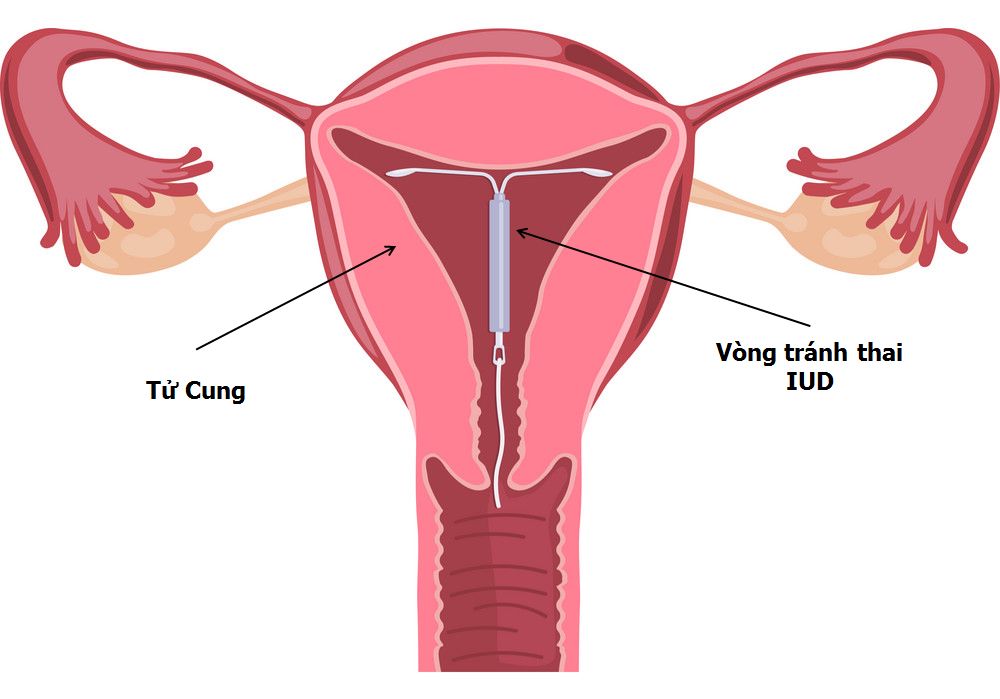 Đặt vòng tránh thai