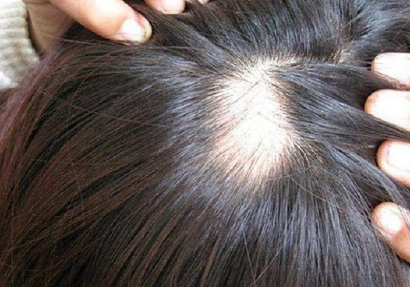 Kỹ thuật mới điều trị rụng tóc gây hói đầu