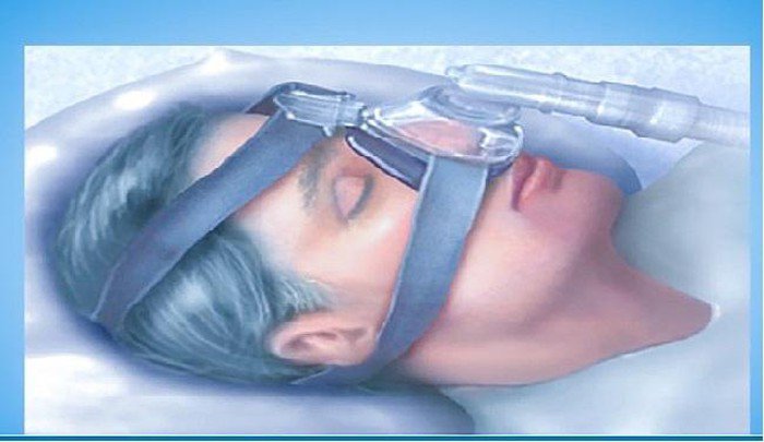 Điều trị hội chứng ngưng thở khi ngủ