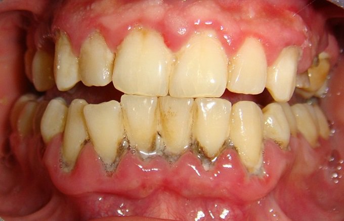 Cao răng đen và 1 số cách khắc phục