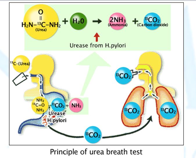 Xét nghiệm hơi thở urê (Urea Breath Test) được sử dụng để phát hiện vi khuẩn HP trong cơ thể người
