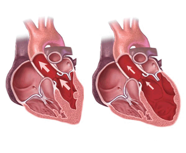 Dấu hiệu và tiêu chuẩn chẩn đoán thấp tim
