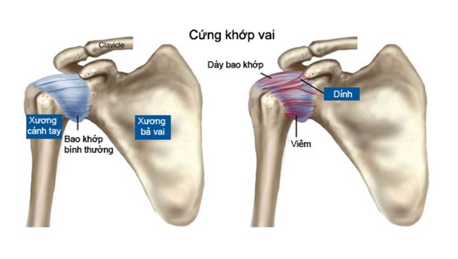 Cứng khớp vai