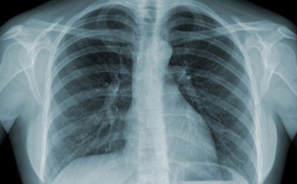 Lưu ý khi chụp CT phổi